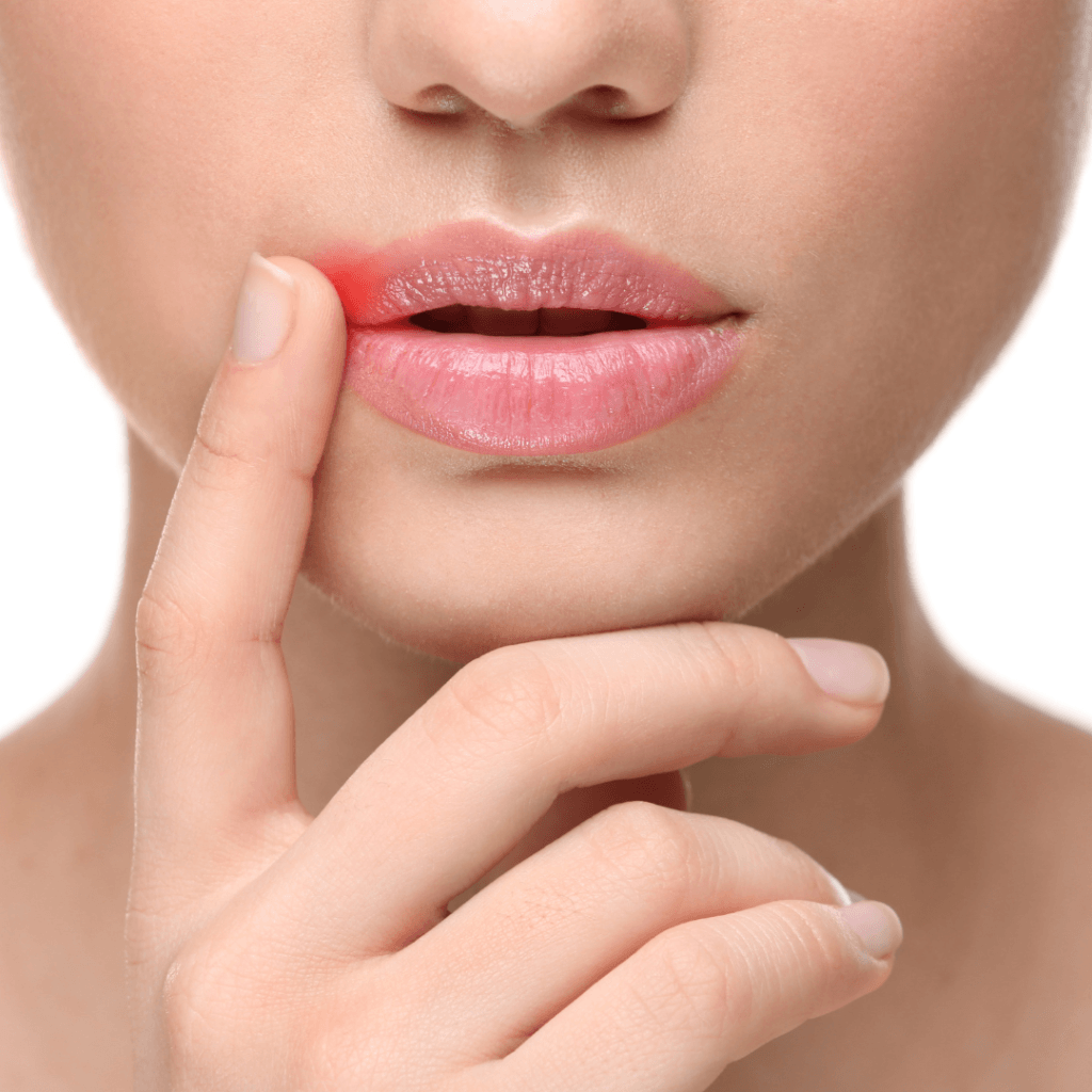 Cold Sores Explained Is it Herpes on Your Lip   Ulta Lab Tests